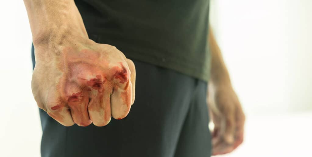  Person with a bloody hand after acting in self defense